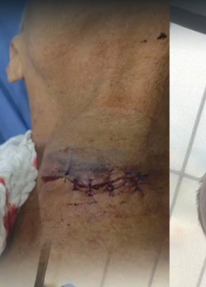 La herida en el cuello.