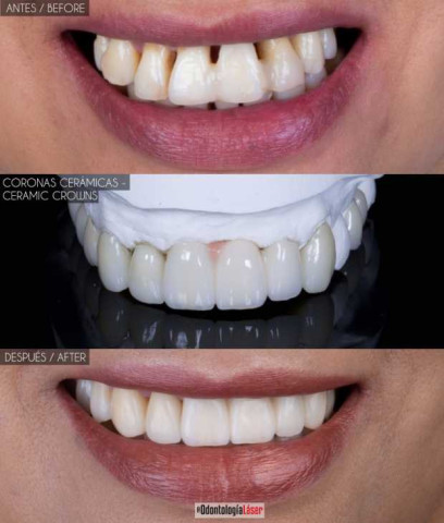 ¿El diseño de sonrisa daña tus dientes?