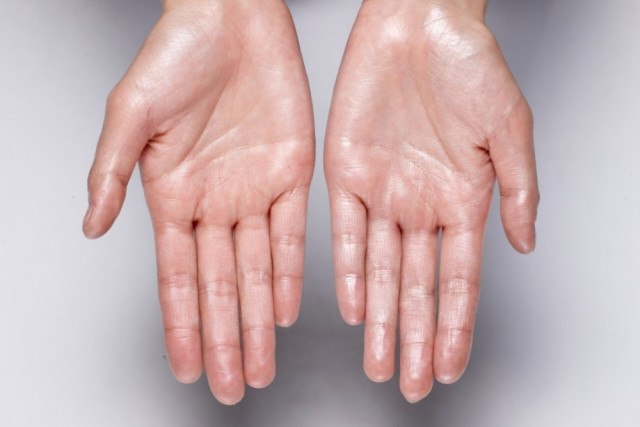 La cirugía no anula la sudoración; educa al cuerpo para que encuentre nuevos caminos y el tacto se use sin la preocupación de que sea algo que incomode.