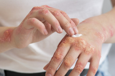 Psoriasis