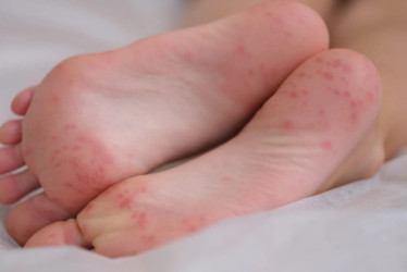 El brote de boca, manos y pies suele ser molesto para los menores de edad. 