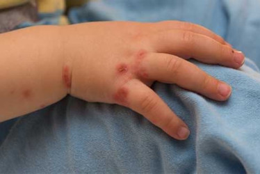 Al menos 81 niños han resultado afectados por esta infección viral altamente contagiosa en instituciones educativas de Dosquebradas y Pereira.
