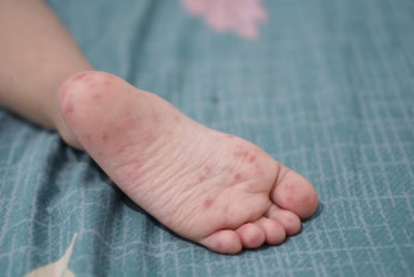 Hay 85 menores contagiados con el síndrome que afecta pies, manos y boca. 