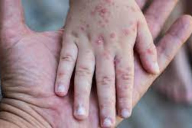 Enfermedad viral afecta a menores en Armenia: 21 centros bajo vigilancia sanitaria