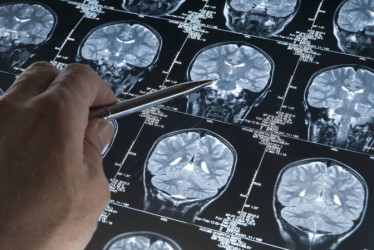 Alzheimer: análisis multiómico abre camino a terapias personalizadas