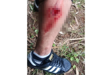 La herida en la pierna de un hincha, causada en la tarde de este lunes cerca del estadio Palogrande, al parecer por el integrante de otra barra.  