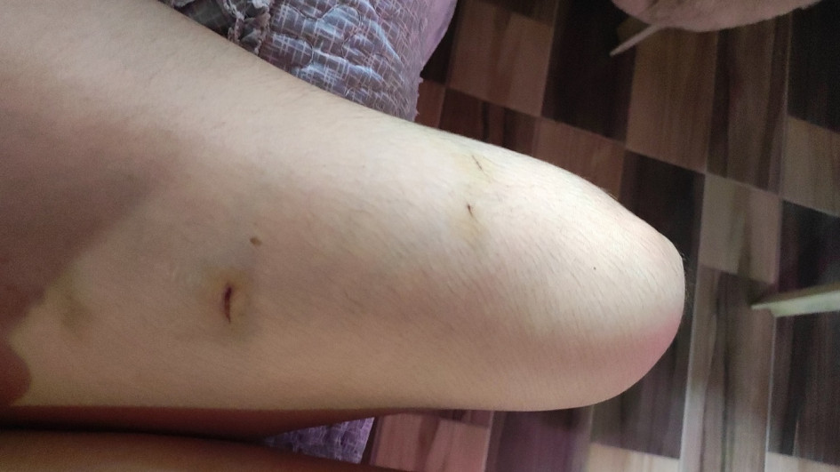 Estas son algunas lesiones que sufrió la mujer.