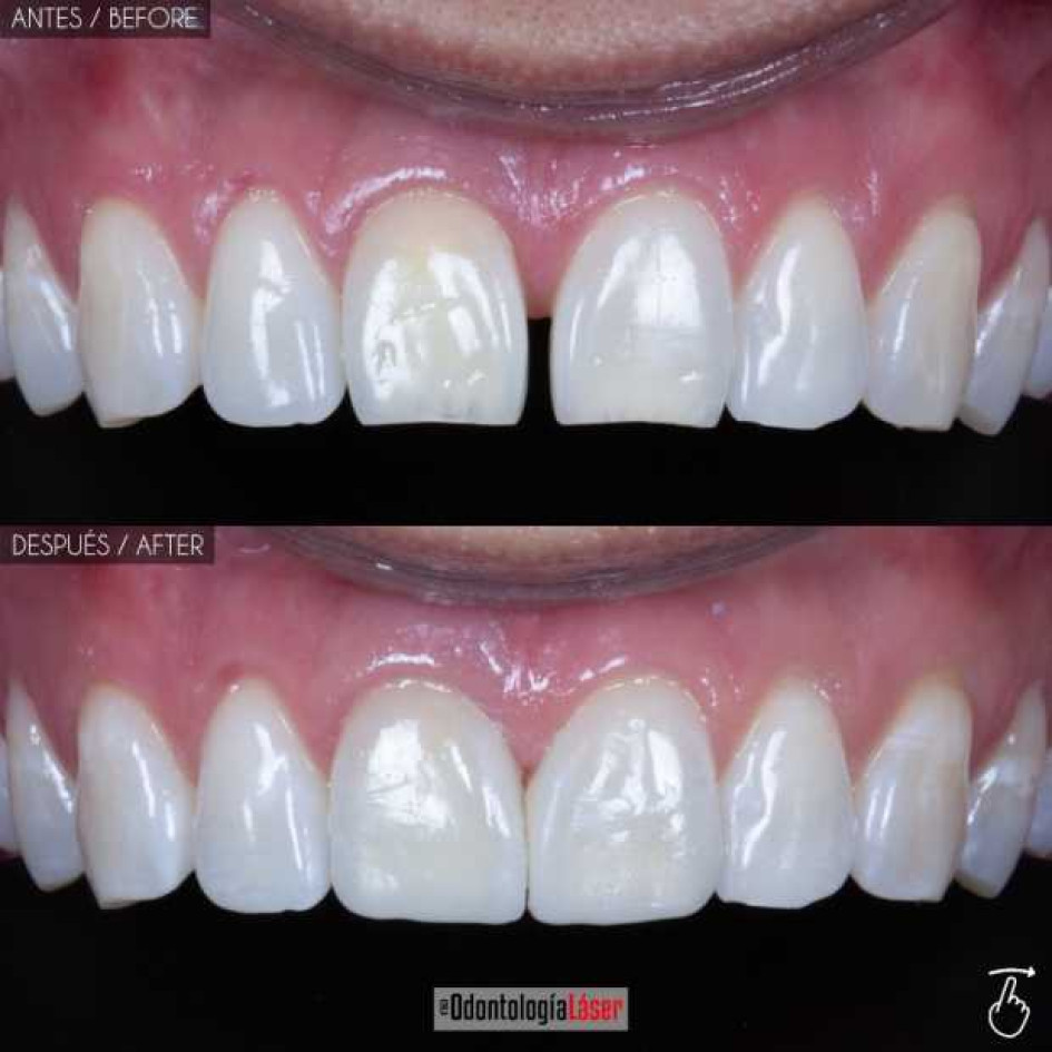 ¿El diseño de sonrisa daña tus dientes?