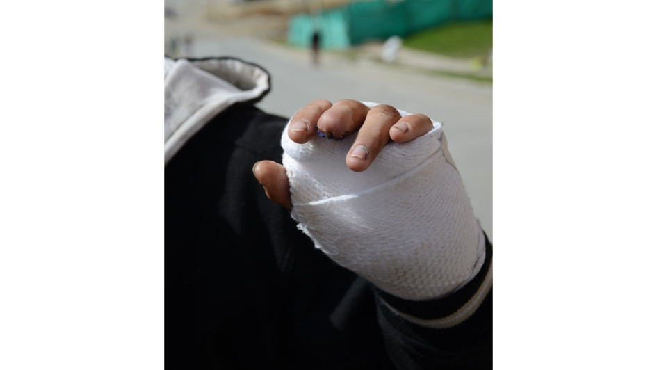 El incremento de casos de quemados por pólvora en Caldas este año, frente al ciclo 2022 - 2023, fue del 67%.