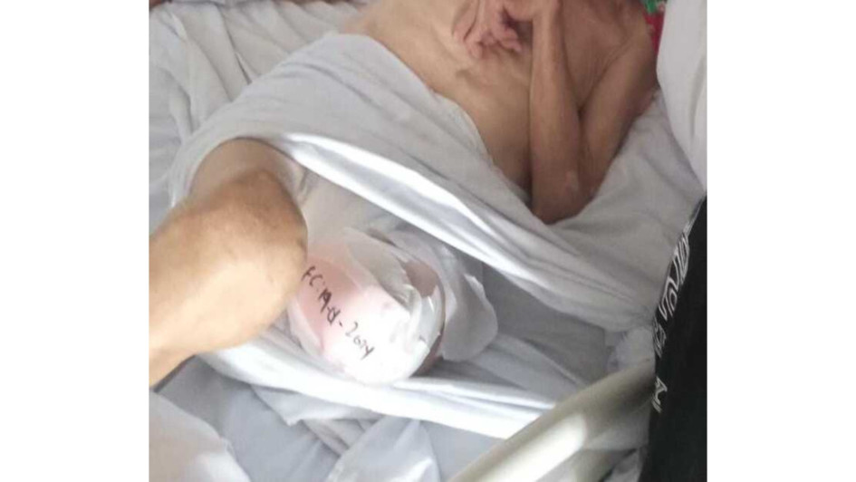 Esta es una imagen de Gildardo Aguirre Suárez, de 91 años, facilitada por sus familiares. La foto se tomó tras la amputación de su miembro inferior izquierdo.