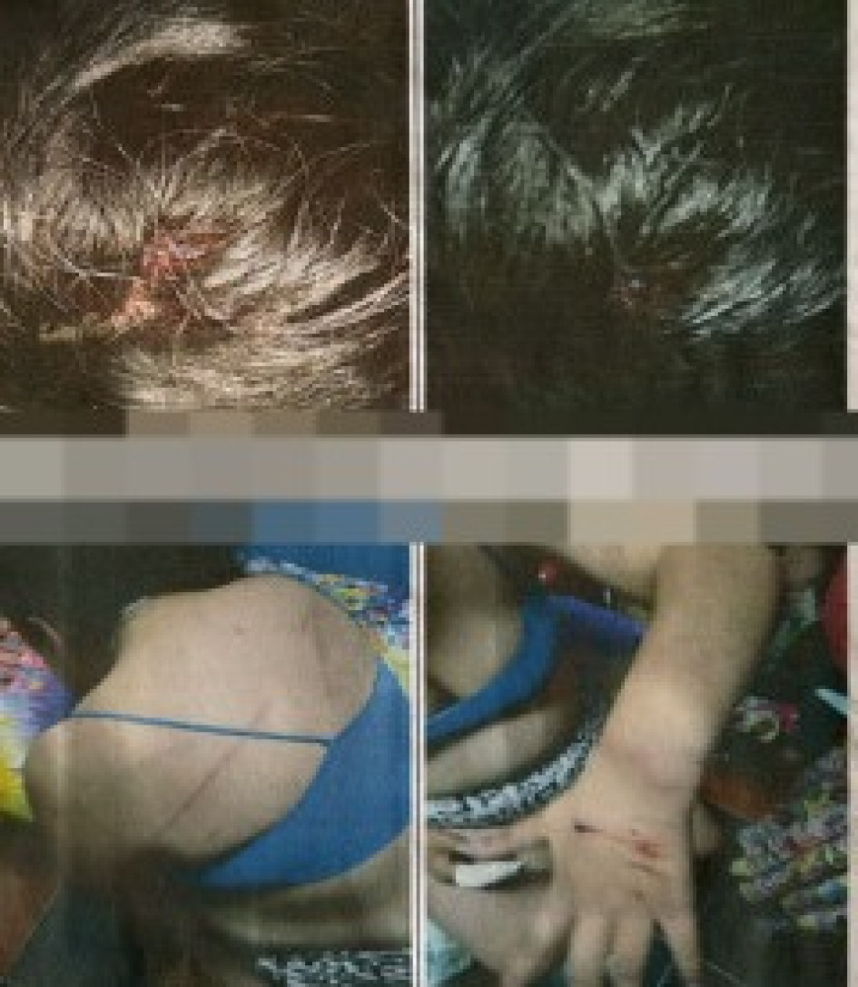 Lesiones que sufrió la víctima durante la convivencia con el sujeto. En dos oportunidades la retuvo contra su voluntad, lo que se convierte en un secuestro.