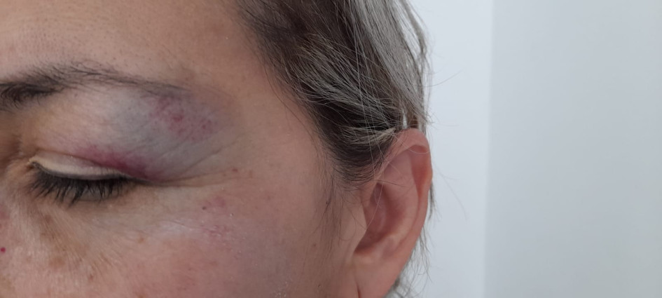 El moretón en el ojo izquierdo de la afectada y el golpe en el brazo derecho. Presentaba dificultad para abrirlo, además de expresar que el dolor de cabeza era fuerte.