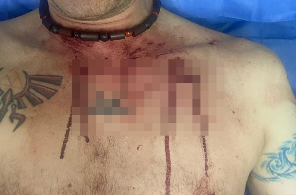 La lesión que sufrió Leandro estuvo cerca de comprometerle órganos vitales.