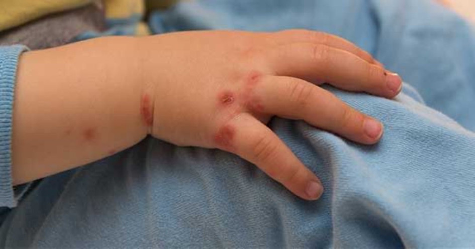 Al menos 81 niños han resultado afectados por esta infección viral altamente contagiosa en instituciones educativas de Dosquebradas y Pereira.