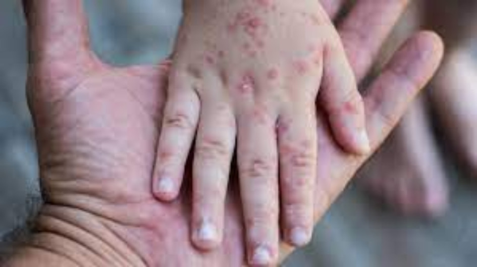 Enfermedad viral afecta a menores en Armenia: 21 centros bajo vigilancia sanitaria