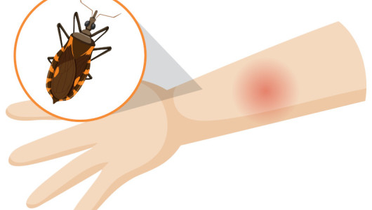 Buscan origen de caso de Enfermedad de Chagas en Riosucio (Caldas)