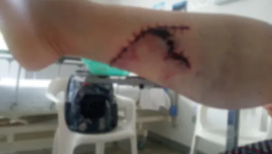 Un pitbull le lesionó una pierna en Pácora, le pusieron 26 puntos