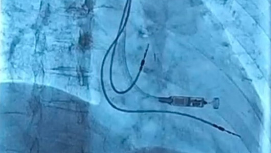 Primer implante en Colombia de marcapasos sin electrodos lo hace un manzanareño en el Hospital de Caldas