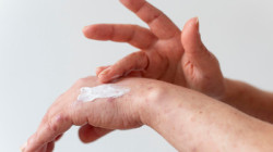 Viruela del mono, activa