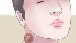 Cómo quitarse un nacido o forúnculo: todo lo que debe saber