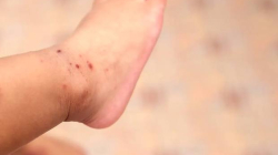 En Manizales alertan a jardines por más casos de la enfermedad de manos, pies y boca 