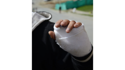 Reportan los dos primeros casos de quemados por pólvora en Caldas en diciembre