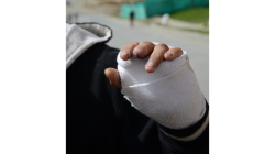 Noche de Navidad deja dos nuevas personas quemadas con pólvora en Manizales