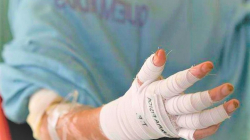 Sube a 47 la cifra de quemados en Caldas: dos casos más en Manizales y otro en San José