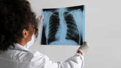 La tuberculosis, con repunte luego de la pandemia