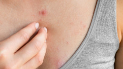 Entienda la viruela del mono y cuídese del contagio