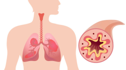 ¿Qué es la fibrosis quística y qué tan complicado puede ser su diagnóstico?, entérese aquí