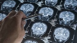 Investigación liderada por colombiano revela cómo progresa el Alzheimer: luces para nuevos tratamientos