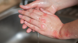 Estos son consejos prácticos para pacientes con dermatitis atópica: lea recomendaciones