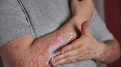 Su piel es tan delicada como una mariposa: conozca la epidermólisis bullosa y lo que sufren los pacientes