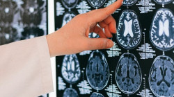 La estimulación cognitiva temprana protege la memoria en el Alzheimer: ¿por qué?