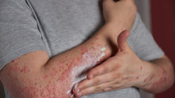 Herpes zóster: más del 99% de los adultos en riesgo y la necesidad de mayor educación médica