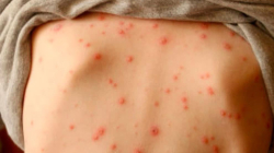 Regresa el sarampión a Colombia, 10 años después: confirman tres casos importados desde el exterior