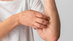 Esto dice la Secretaría de Salud Pública de Manizales de estudiantes con varicela: ¿qué esperan?