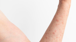 Este país de Suramérica activa alerta tras detectar caso de variante de mpox: ¿puede llegar a Colombia?